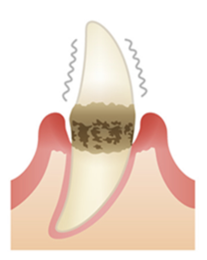 中等度の歯周病を表す画像